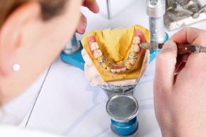 After a dentist makes mold of your mouth using a soft putty, it's sent to a lab so that the bridge can be manufactured.