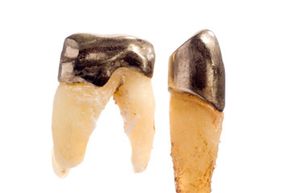 gold dental crowns in teeth