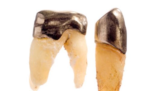 Dental Crowns