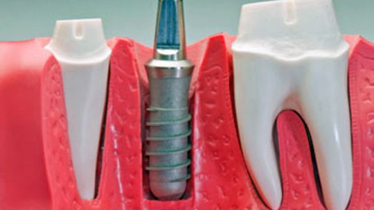 Dental Implant Procedure