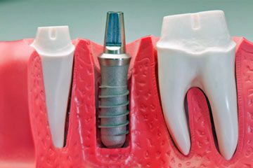 dental implant model