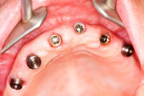 dental implants in a human mouth