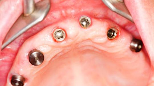 Dental Implant Problems