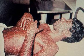 The telltale red pustules on this man identify him as being affected with smallpox. Although the disease has been eliminated from Earth in natural form, fears of smallpox use as a bioterrorism weapon continue.