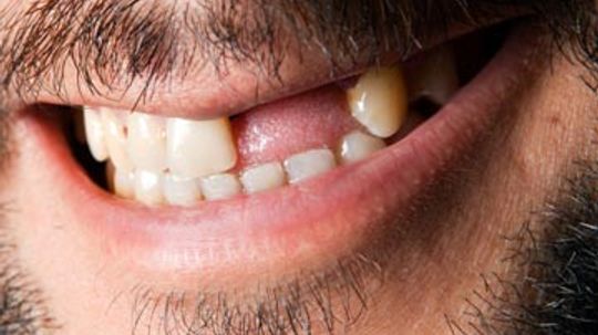 What diseases are associated with tooth loss?