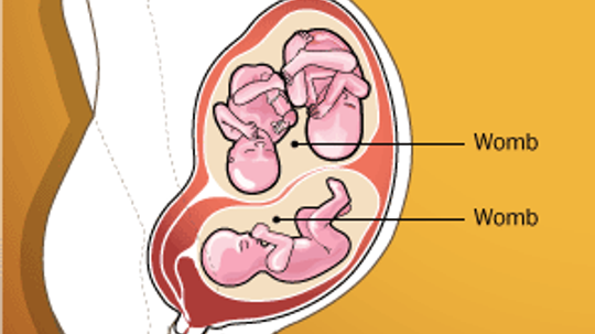 If a Woman Has Two Wombs, Can She Get Pregnant in Both?