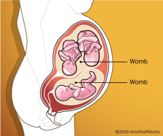 If a Woman Has Two Wombs, Can She Get Pregnant in Both?