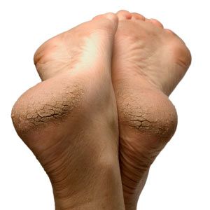 Close up of woman's cracked dry heels.