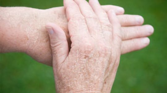 What can I do for extremely dry hands?