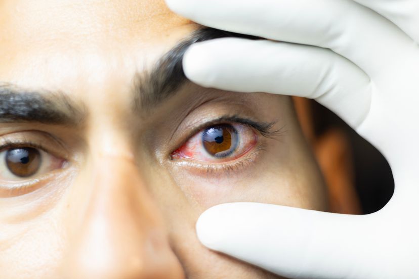 wide open eye of an Indian Man suffering from conjunctivitis or eye flue.