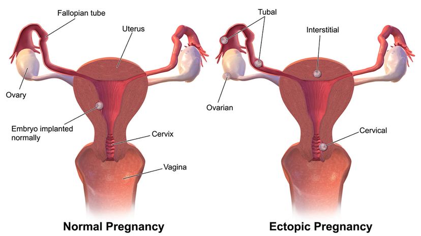 Ectopic pregnancy