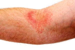 Eczema rash on right inner forearm.