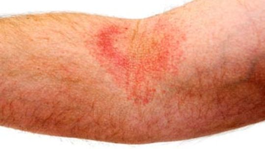 Eczema Basics