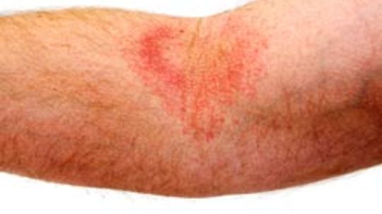 gluten rash