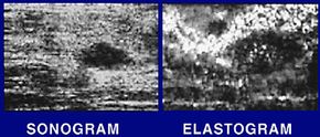 On the left is an ultrasound image of breast scan, which shows a tumorous growth as a large, dark spot. On the right is an elastograph of the same breast. The elastograph gives a clearer image of the tumor and shows it to be larger than the sonogram reveals. It also captures a second, smaller tumor (to the left of the larger one) that didn't show up on the sonogram.
