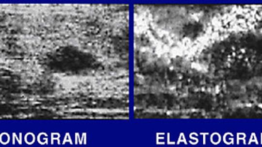 Will elastography replace biopsies for confirming a cancer diagnosis?