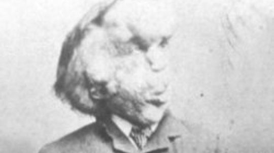 The Elephant Man Image Gallery