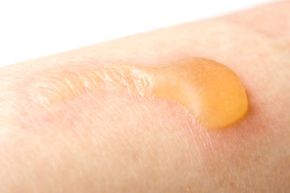 Burn blisters can form on the skin of people with EB simply from changes in room temperature.