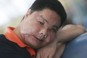 Li Guoxing in July 2006, after the first stage of his face transplant
