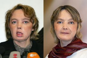 Isabelle Dinoire, the first face transplant recipient, a few months after her operation and a year later