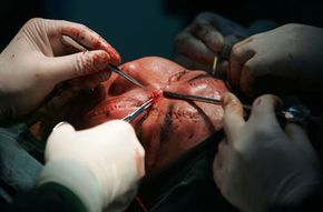 Patient receives the second stage of his face transplant