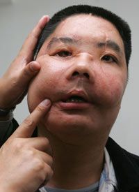 Li Guoxing the day before the second stage of his face transplant in November 2006