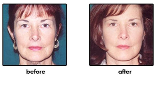 Facelifts: What You Need to Know