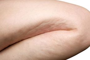 detail of cellulite on woman leg isolated on white