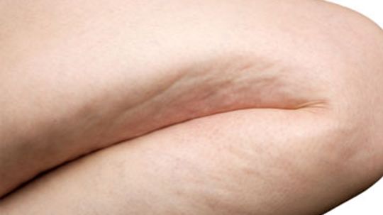 Will fasting get rid of cellulite?
