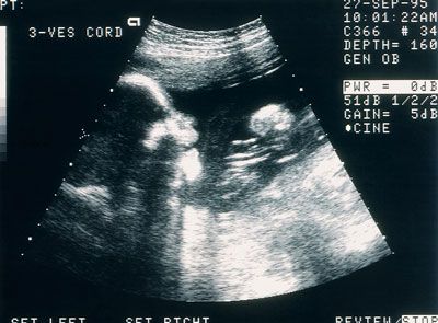 fetus sonogram