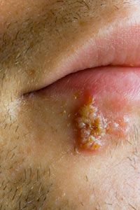 Pronounced fever blister on man's lower lip