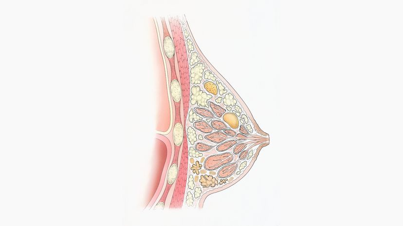 Illustration of fibrocystic breast disease