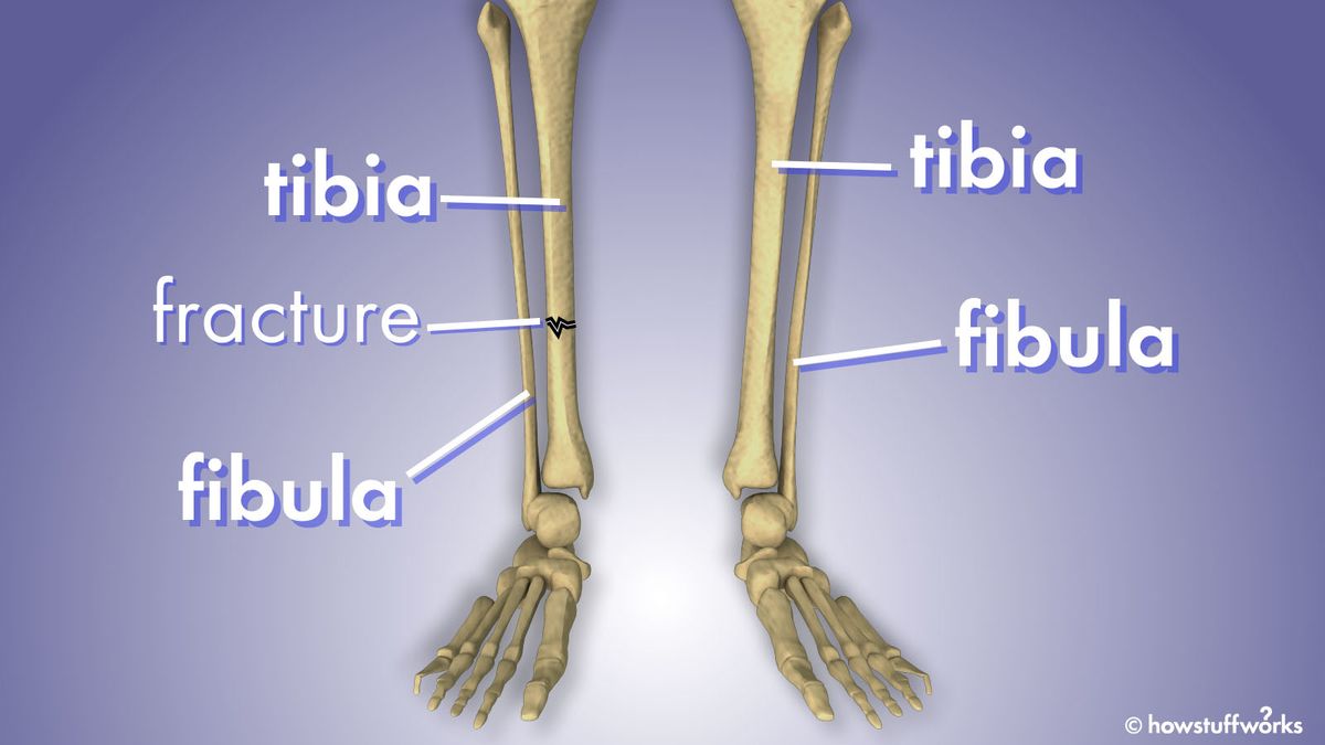 Tibia and Fibula 