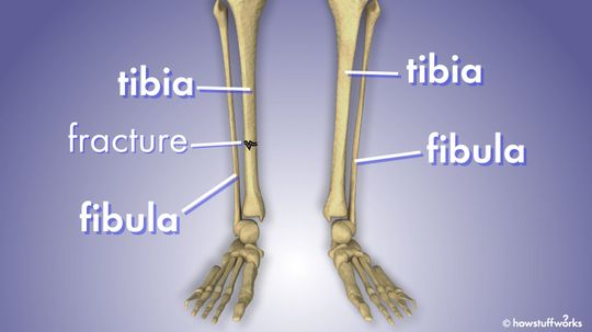 What's the Difference Between the Fibula and Tibia?