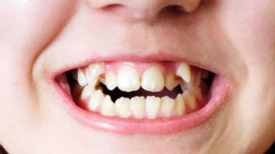 How to Fix Overlapped Teeth