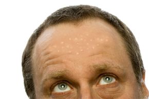 Flat warts aren't as big as common warts, but they're still a cosmetic problem. See more pictures of skin problems.