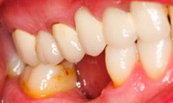 Teeth and gums with plaque, tartar and gingivitis.