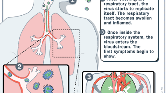 What is the Flu?