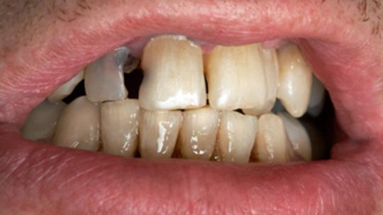 Can fluoride make your teeth yellow?