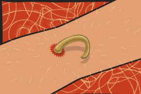 Normally, if you have a parasitic worm in your body, you should get a prescription for some anti-nematode medication.  But in desperate circumstances, you can pull it out yourself.