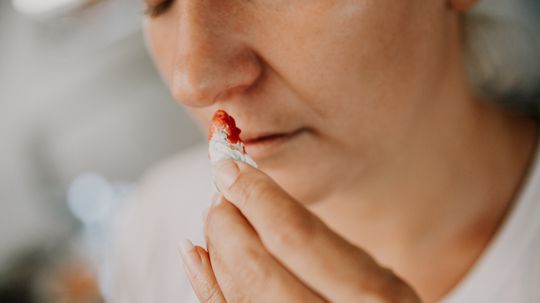 11 Home Remedies for Nosebleeds