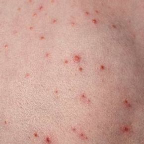 Folliculitis occurs when hair follicles become clogged by bacteria, fungus, yeast or sebum. See more pictures of skin problems.