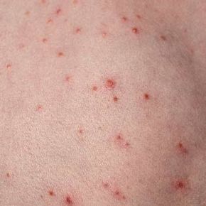 Folliculitis: Causes, Risks, And Treatment FullyVital