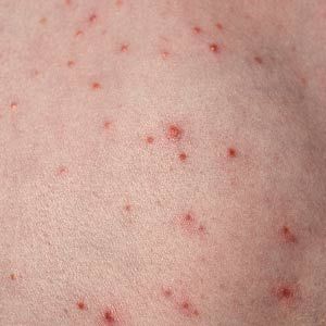 Folliculitis on child's back.