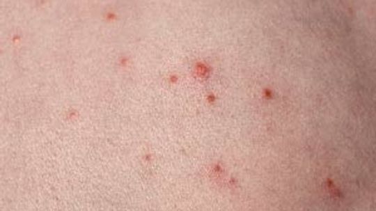 Folliculitis Overview