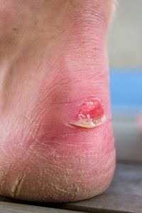 Man's heel with blister and very dry skin.