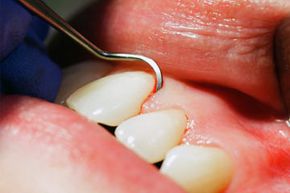 Periodontal probes are marked with grooves that measure the deepness of pockets between the gums and teeth. Dentists slide the probe gently into the gum line and note where the tip stops to determine how much gum disease has progressed.