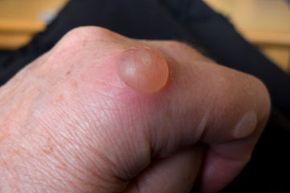 bullosa leads to painful blisters from slight temperature and pressure.