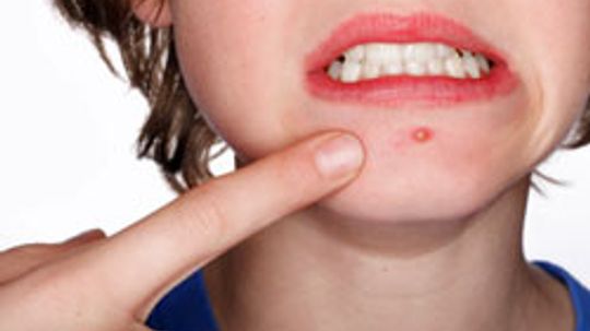 Can food allergies cause acne?