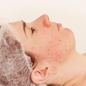 Woman getting acne scar treatment.